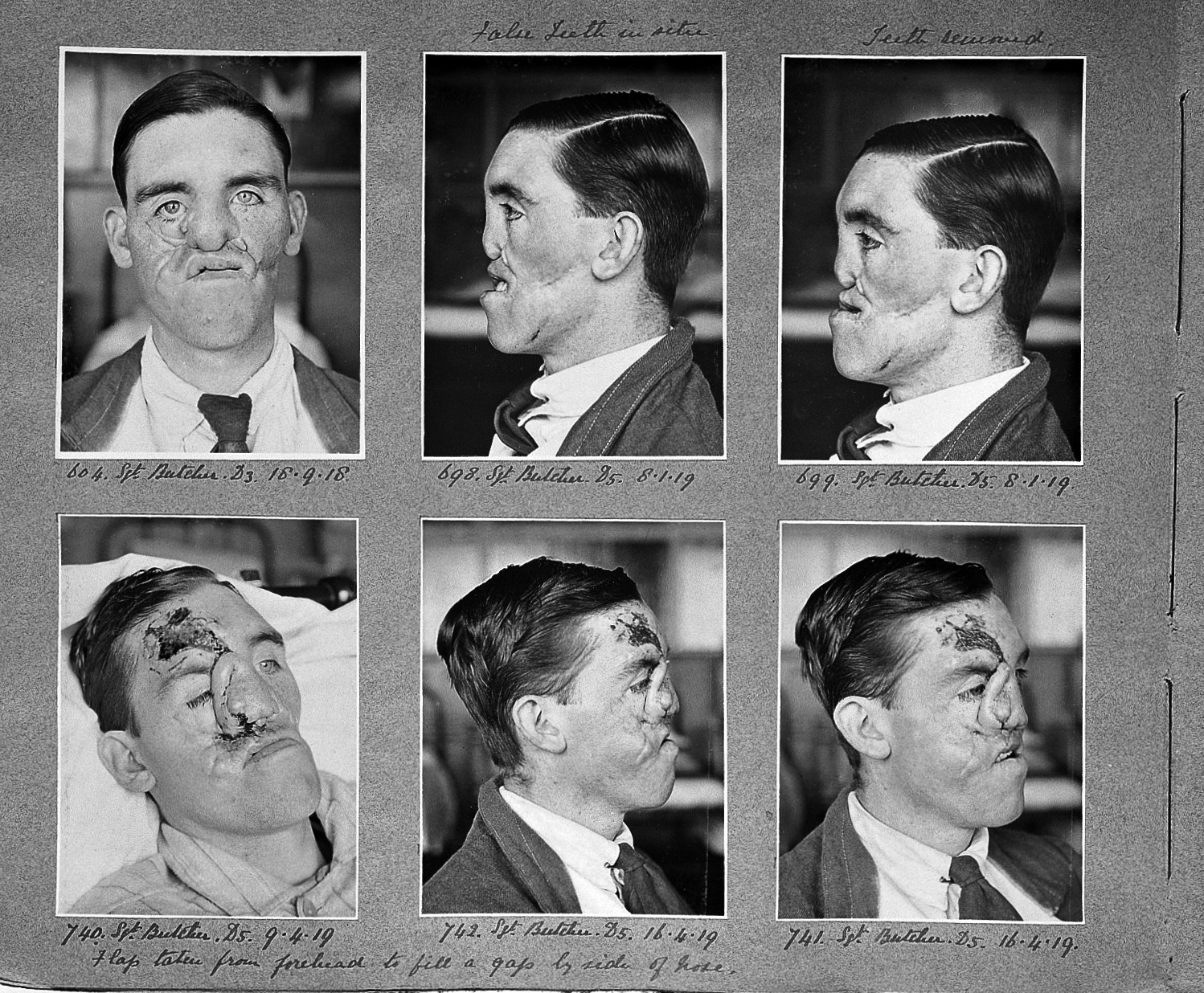 Sgt Butcher - WW1 - plastic surgery